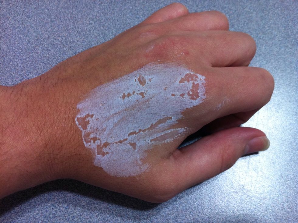 1. Apply Mylanta or any generic brand to the affected area using cotton balls. 2. Now let it dry until it becomes all white. (Can use a blow dryer) (Make sure is not to hot for the baby skin)