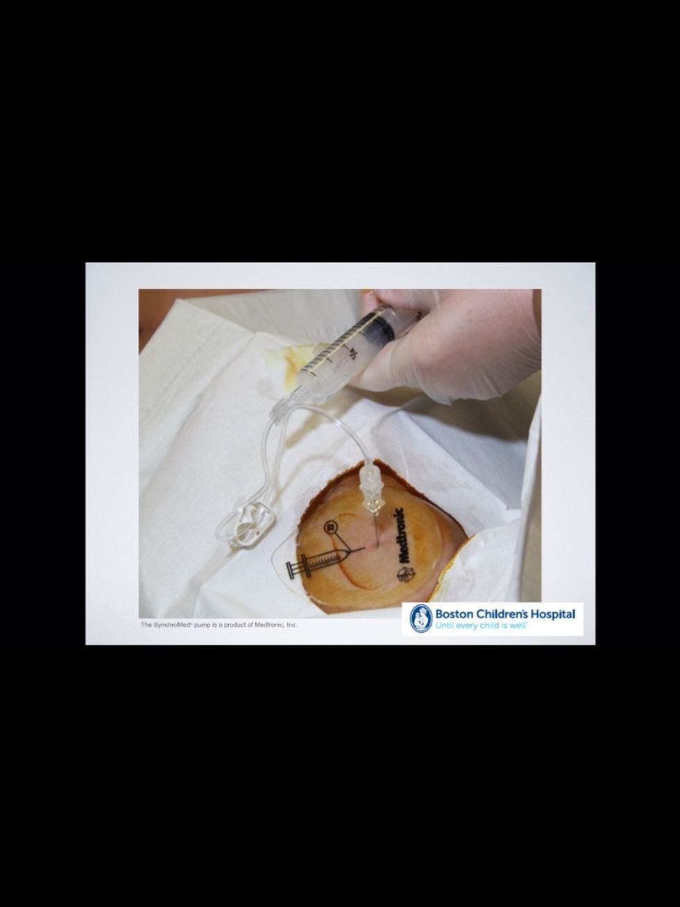 How to prepare for a baclofen refill B+C Guides