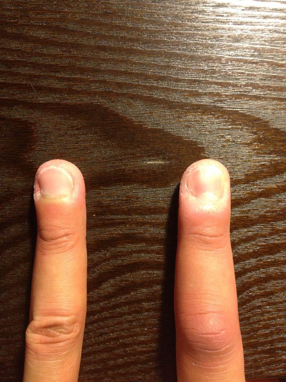 After an aggressive game of basketball, you may find yourself with a jammed finger. The finger on the right is noticeably swollen compared to the left. Remember to ice it ASAP to reduce the swelling.