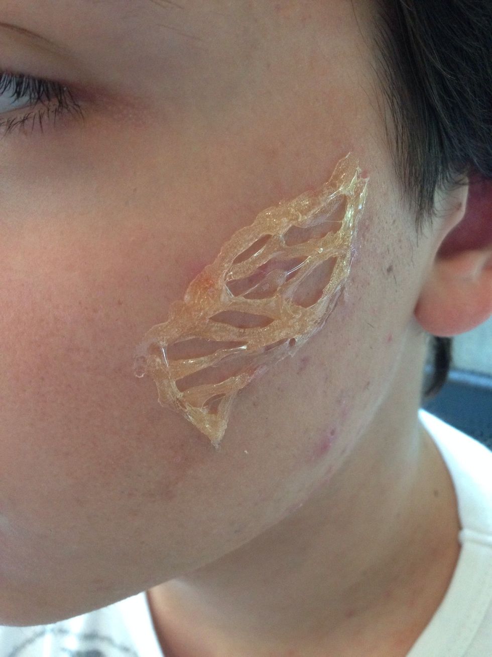 Apply the skinplastic