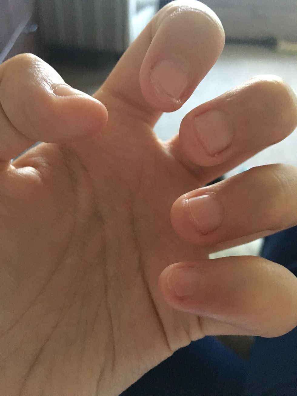 Been trying really hard to stop biting them but am finding it very hard. They are short but not beyond repair. Going to keep applying the growth formula twice a day and will keep treating my cuticles.