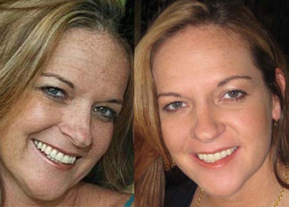 Chandra \u2013 Before & After using the REVERSE Regimen