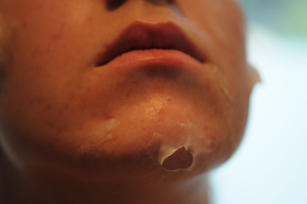 create open blister by making a bump and taking the top part of