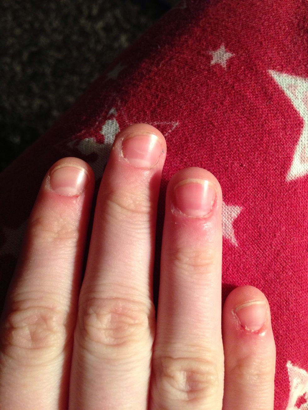 Day 10. This much of an improvement will almost stop you from biting. Remember: healthy cuticles means a healthy nail! It is good to have a bit of a cuticle, but not a lot, as shown in the next slide