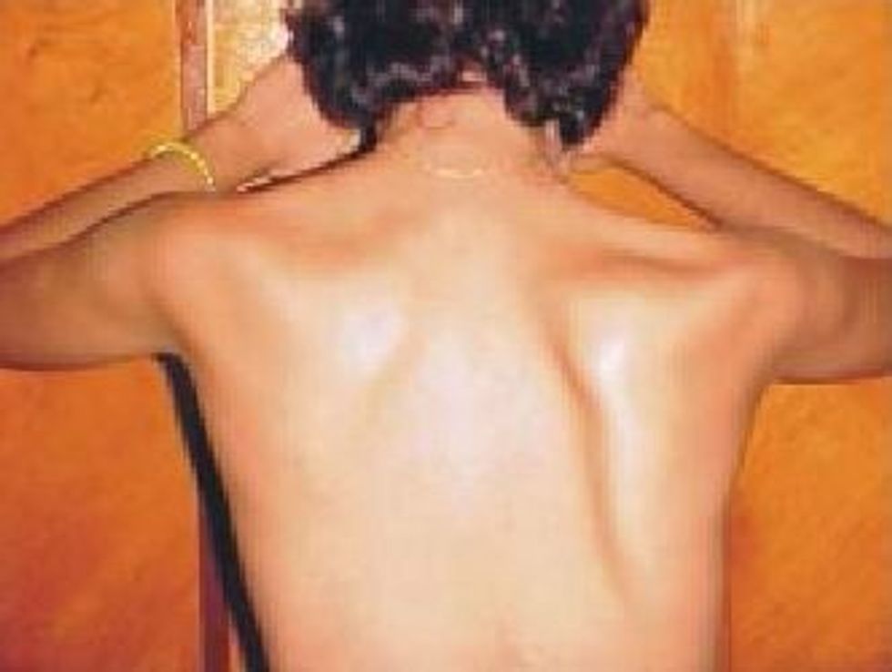 Deformidad alada de la esc\u00e1pula Pida al paciente extienda los brazos y se apoye en la pared Deformidad alada =debilidad del m\u00fasculo serrato anterior - distrof\u00eda muscular o lesi\u00f3n nervio tor\u00e1cico largo