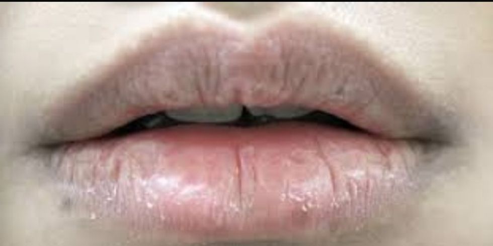 Do you have dry chapped lips? Fix it!