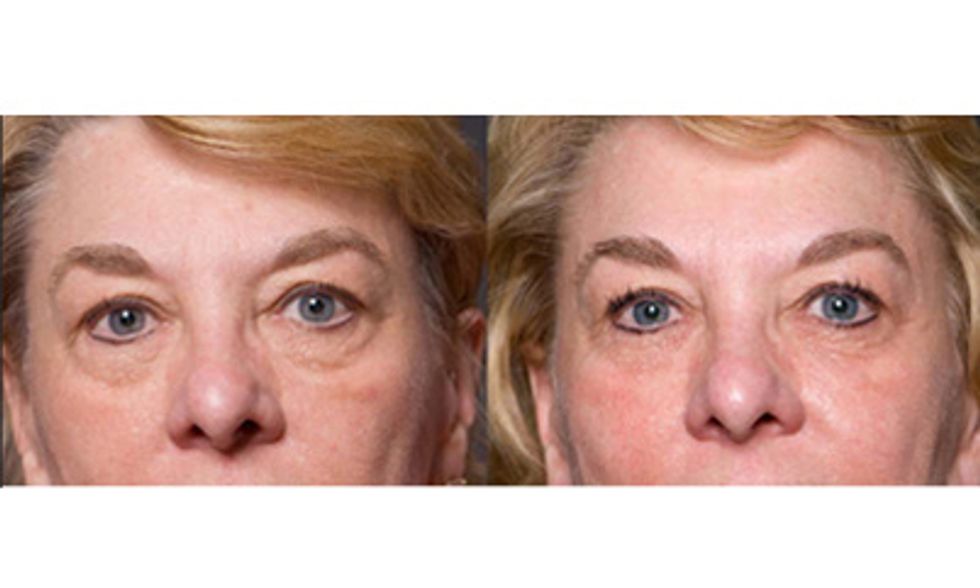 Donna - Before & After using the REDEFINE Regimen