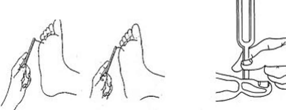 En la sensibilidad vibratoria y postural empezar por dedos de manos y de pies. Si es normal se infiere que zonas m\u00e1s pr\u00f3ximales as\u00ed ser\u00e1, en p\u00e9rdidas de sensibilidad delimitar contorn\u00f3 causal.