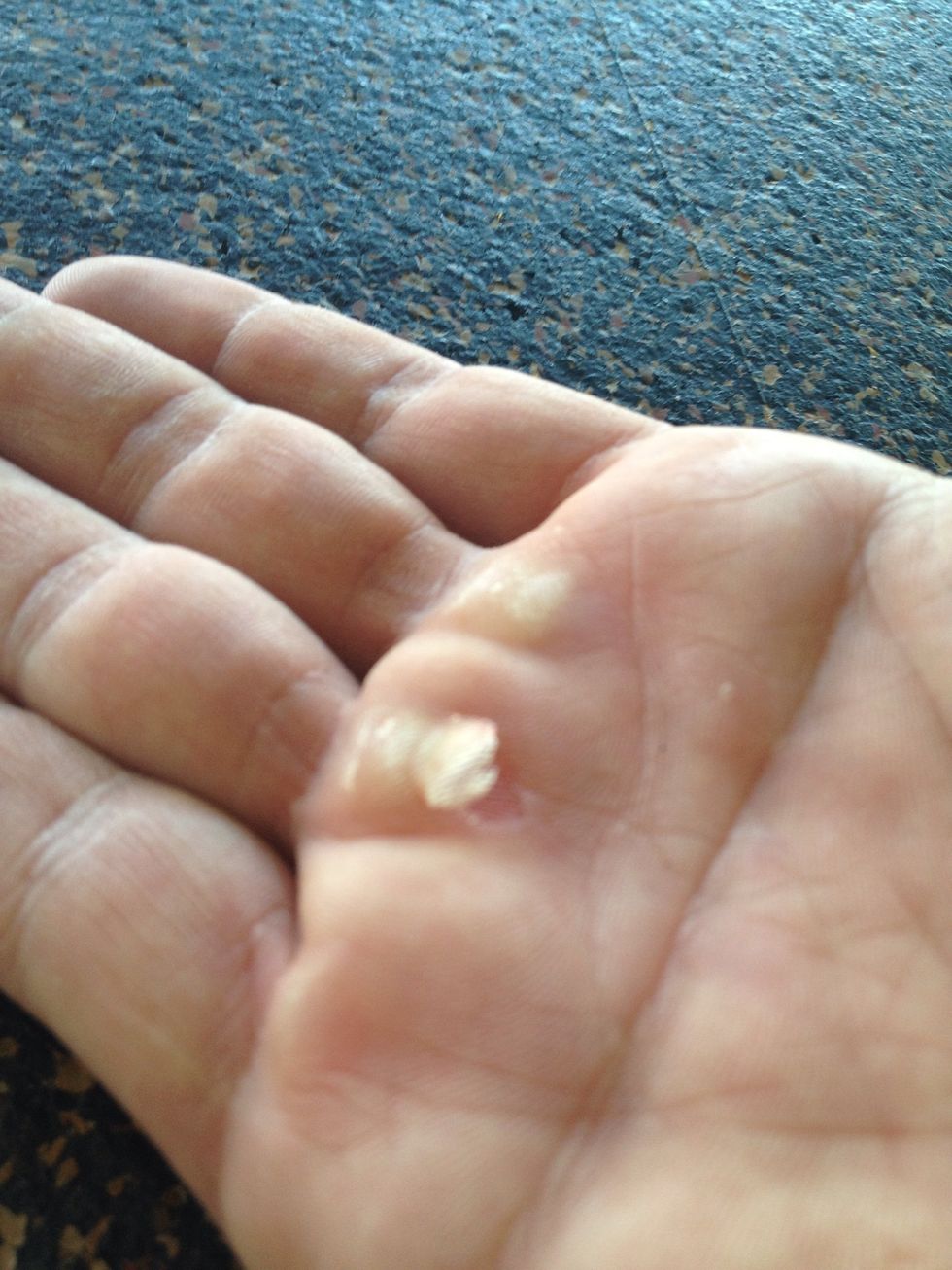 How to heal ripped callous hands B+C Guides