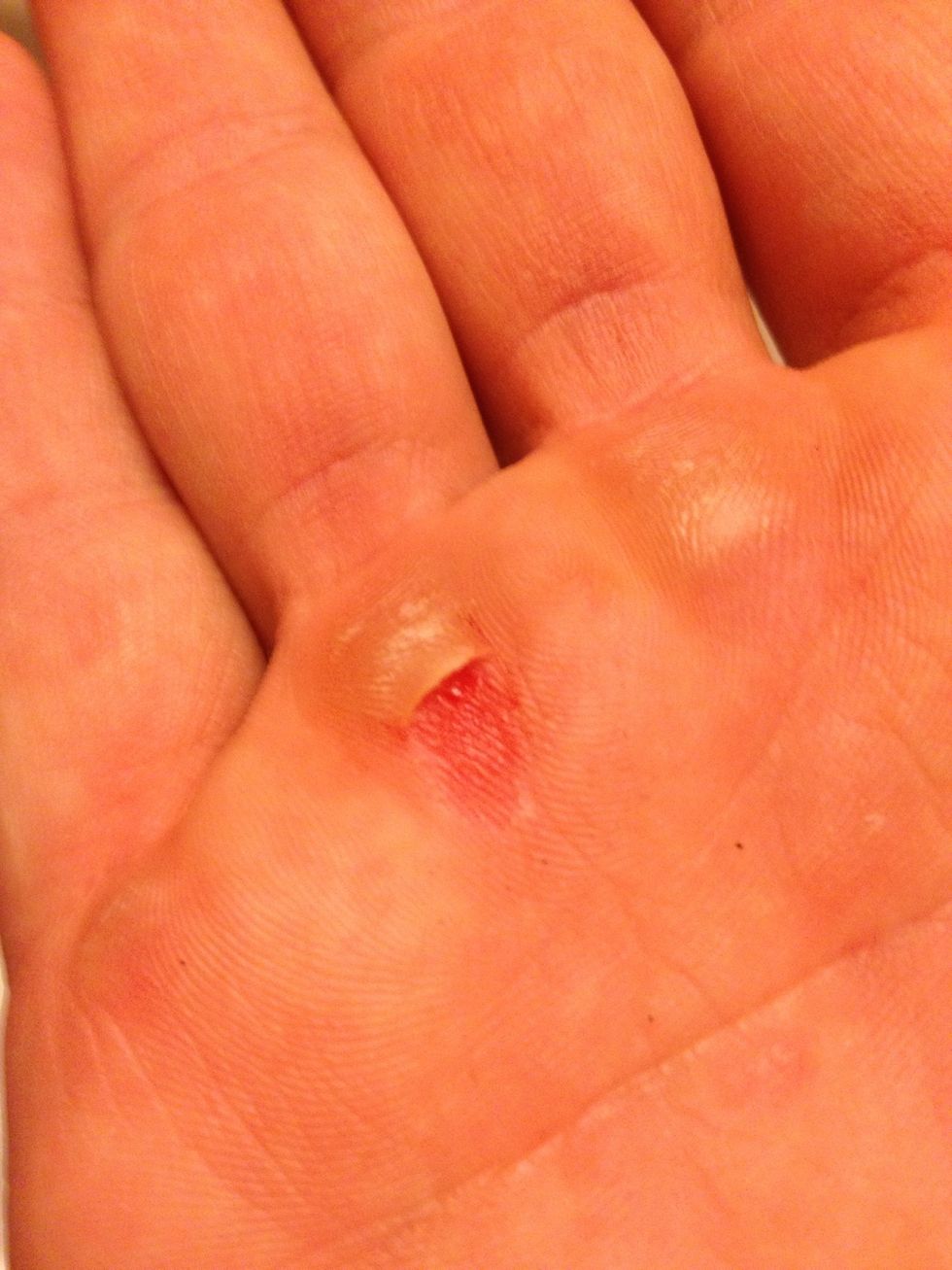 How to heal ripped callous hands B+C Guides