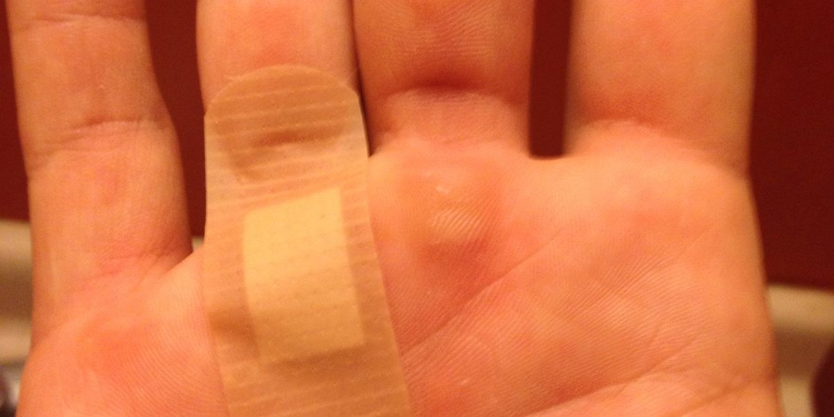 How to heal ripped callous hands B+C Guides