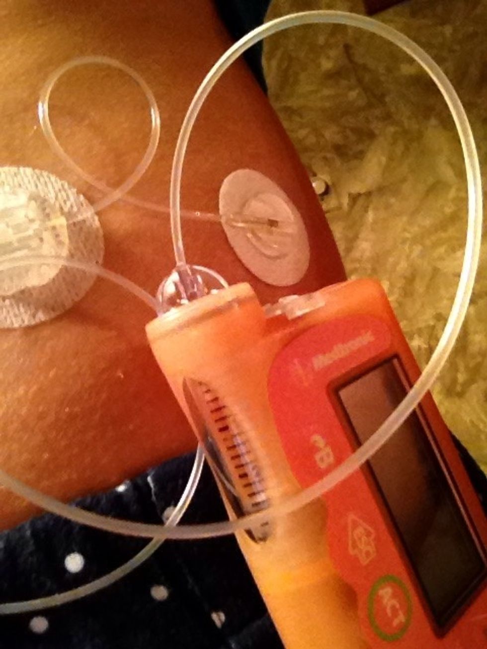 How to set up a medtronic pump site B+C Guides