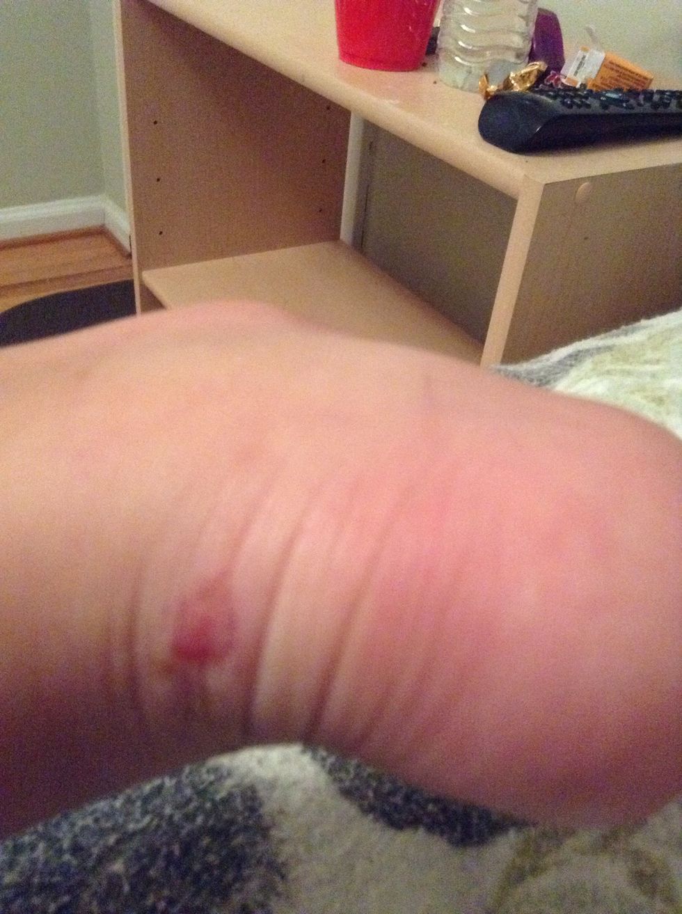 I got a blister on my ankle\ud83d\ude22