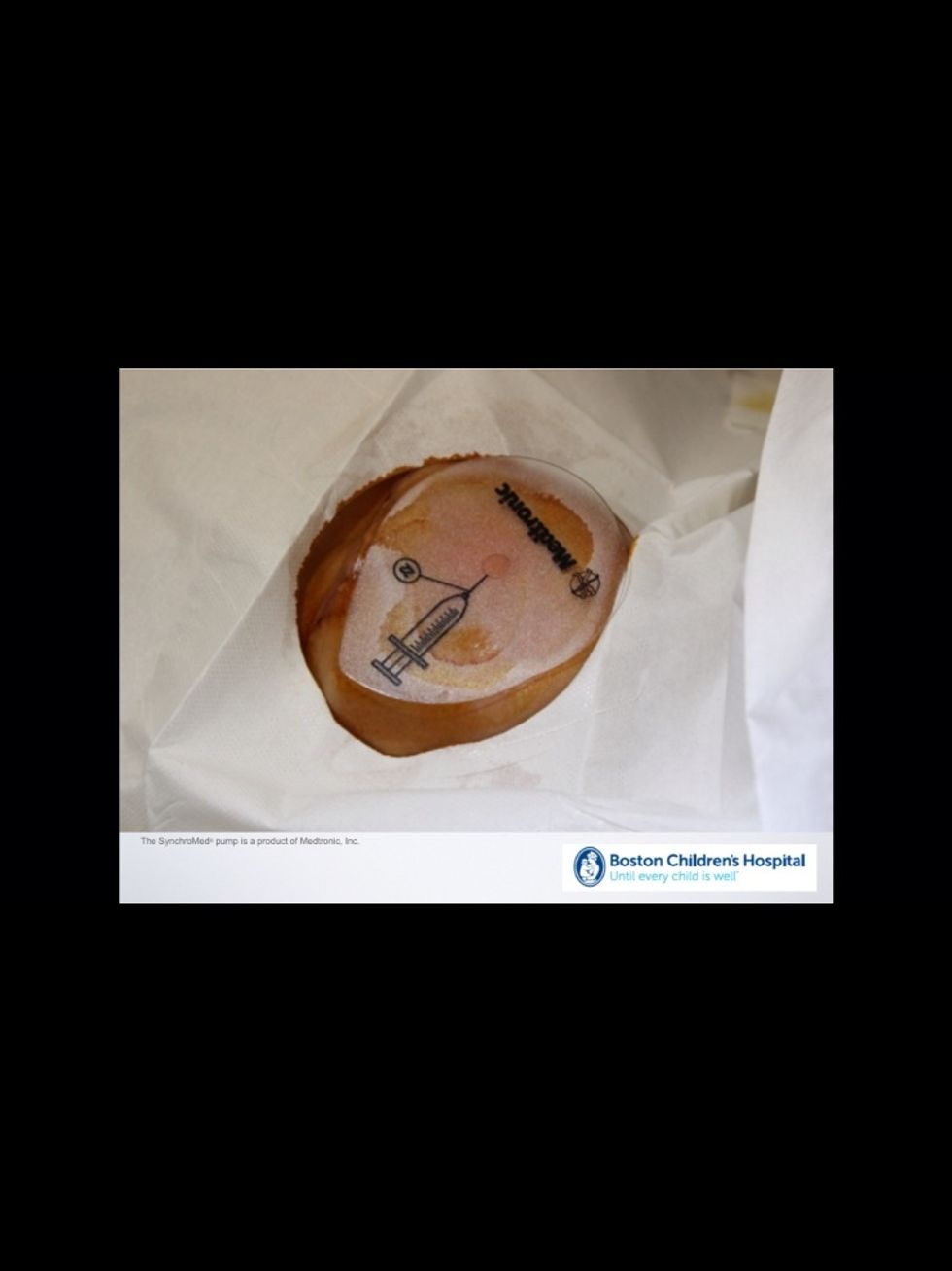 How to prepare for a baclofen refill B+C Guides