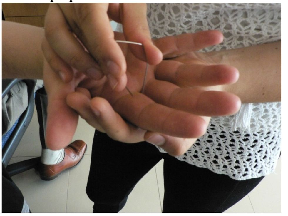 La discriminaci\u00f3n de dos puntos permite identificar la distancia m\u00ednima en la cual el paciente puede discriminar uno de dos puntos. Con un clip, presione la yema del dedo de la mano del paciente.