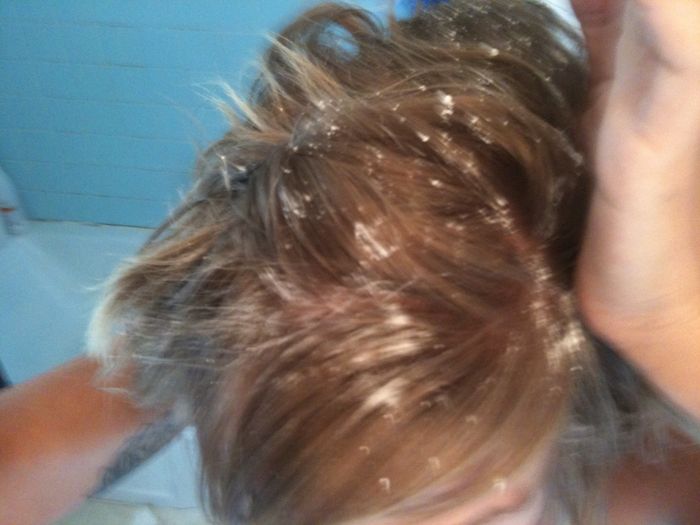 my hair was pretty greasy today - I'm not sure the photo does it justice. Using hands, sprinkle corn starch (found in baking aisle) on hair line where grease builds up.