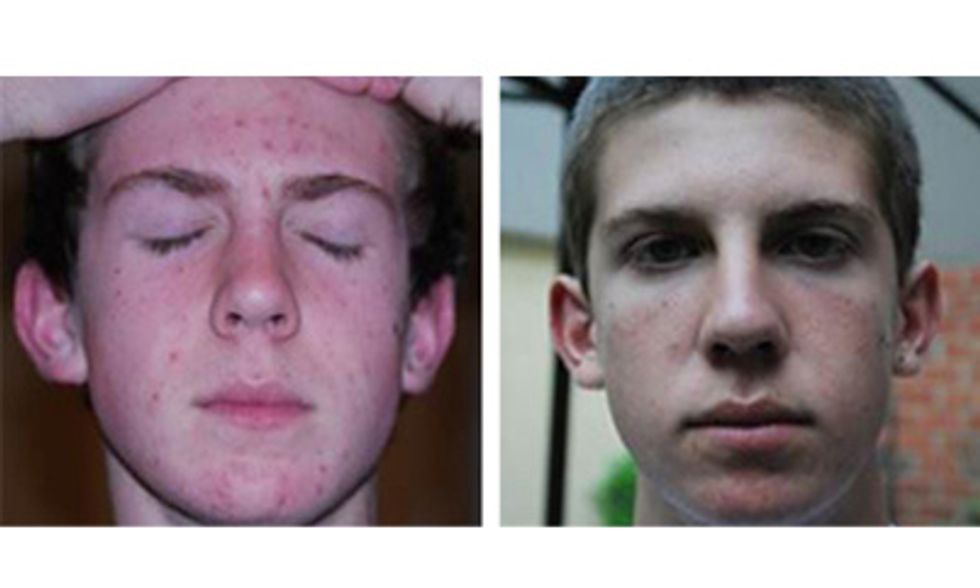 Nathan \u2013 Before & After using the UNBLEMISH Regimen
