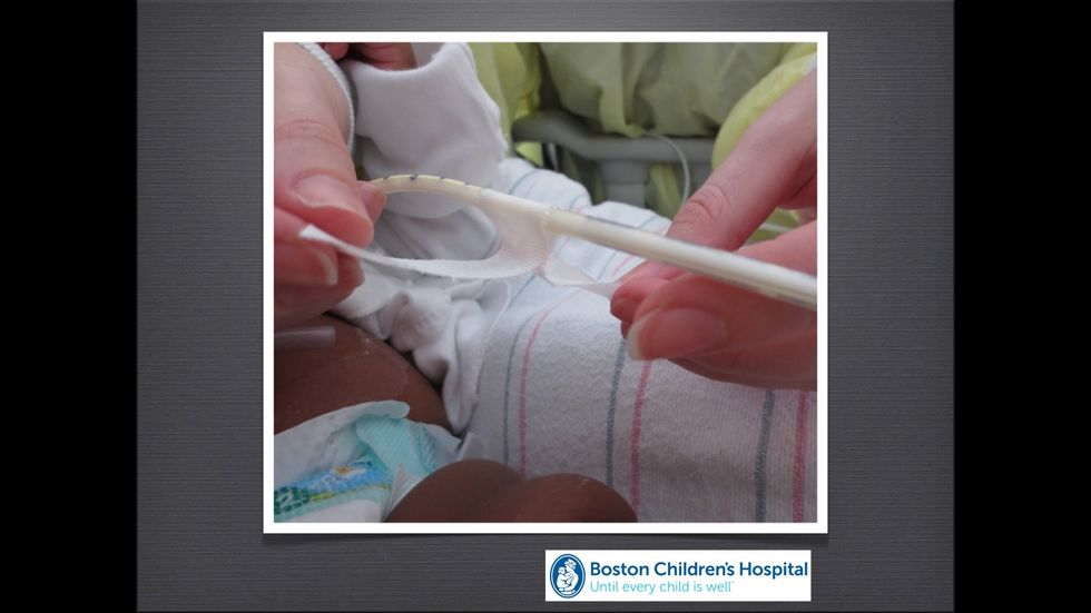 Pinch the tape to itself (together) under the PEG tube to form a "tape tent". There should be extra tape on either side of the tube to stick onto the skin.