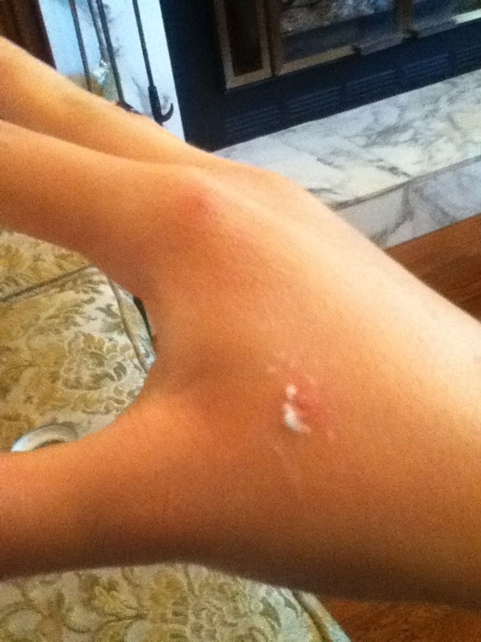 Put it on! It is really nice smelling and works good! It'll sting if you already scratched it a bit, but still works:)