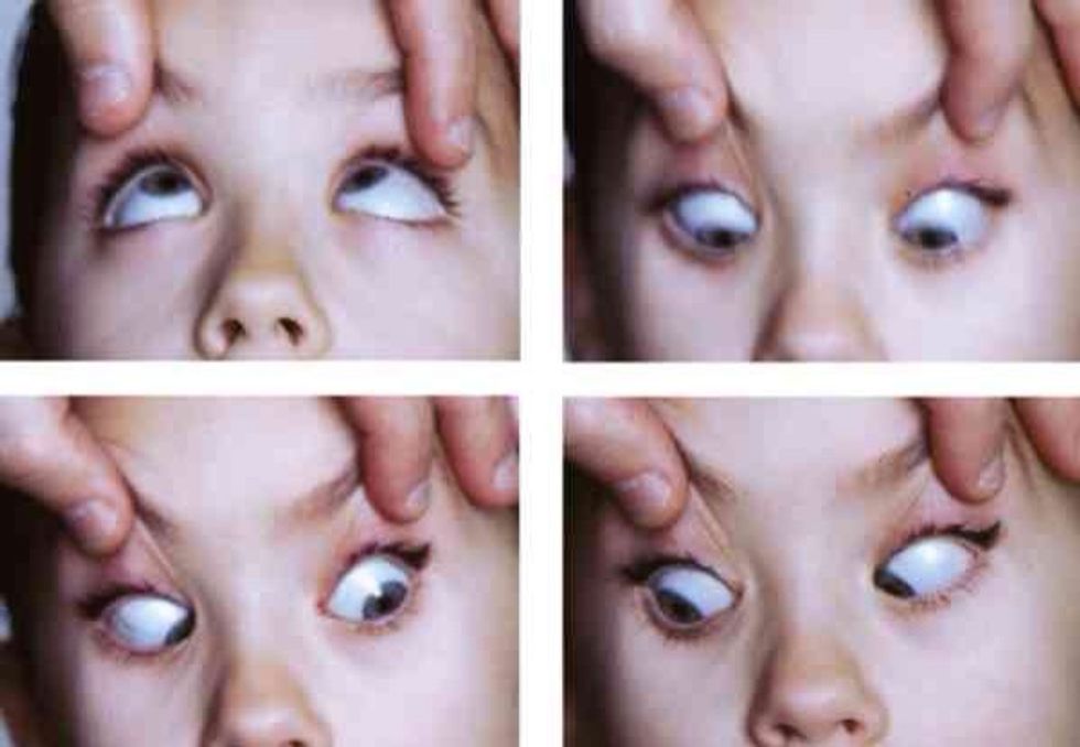 Reflejo oculocef\u00e1lico (mov en ojo de mu\u00f1eca)   Examina la funci\u00f3n del tronco encef\u00e1lico de un paciente comatoso Mantenga abiertos los p\u00e1rpados superiores, gire la cabeza a un lado y luego al otro