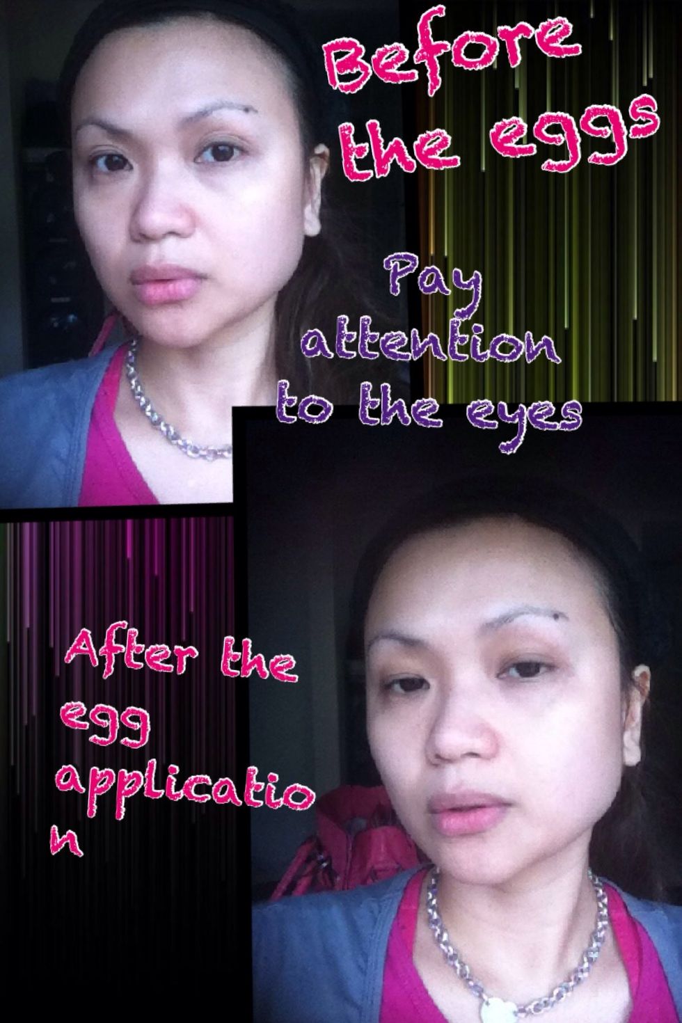 Showing you the before and after effect. My eyelids doesn't seem to have extra skin. My dark circle is not as bad as well.