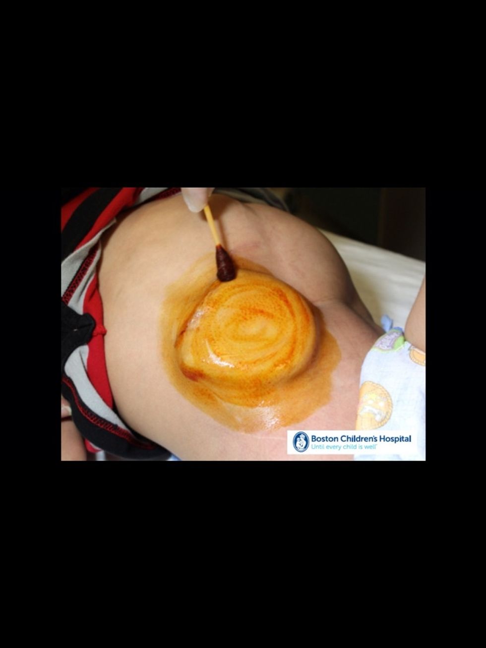 The area over and around the pump will be cleaned with a topical antiseptic solution to eliminate any germs in the area.