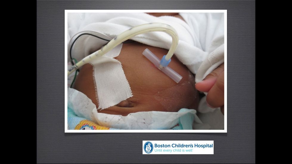 The loop should be big enough so that the PEG tube enters the stoma at a 90 degree angle to prevent any tension or pulling of the stoma.