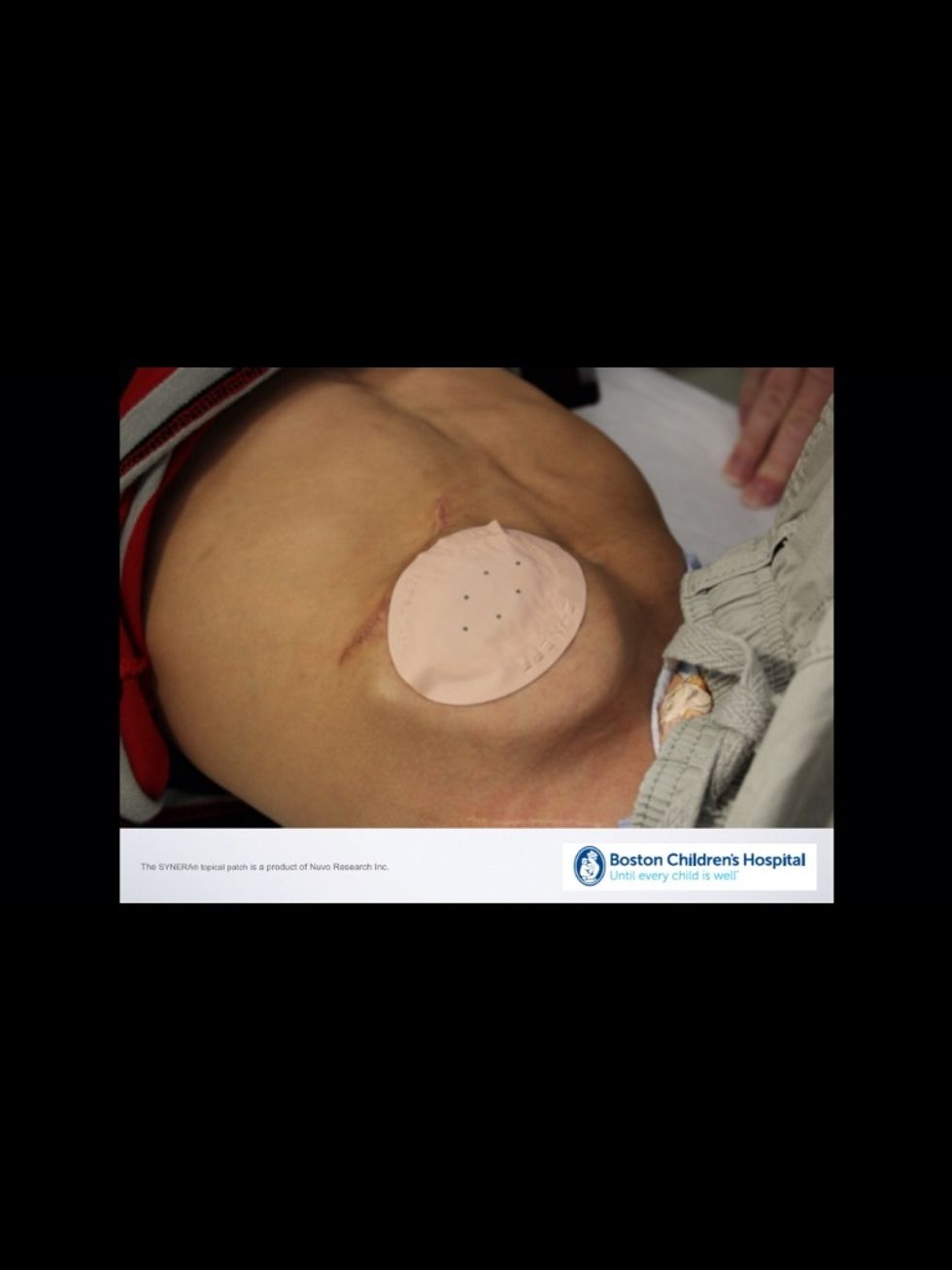 The skin over the pump will be numbed so your child will not feel the needle stick. The patch or cream will stay on for 20 - 45 minutes before the procedure starts.