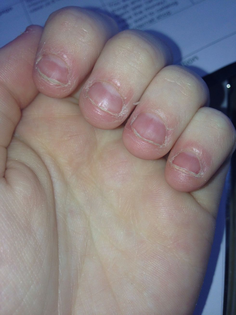 These are my nails as of now. I relapsed very badly, but like I said, this is normal. It looks stupid, but it really helps if I wear surgical gloves. I can't pick at my nails nor can I feel them.