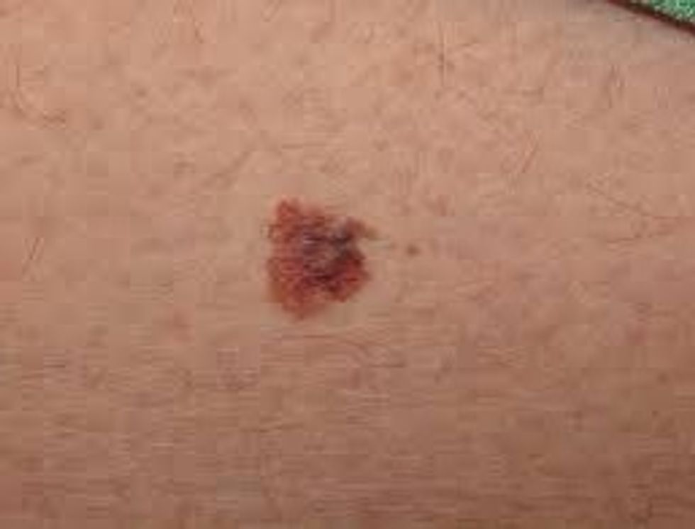 This is a photo of melanoma before it spreads