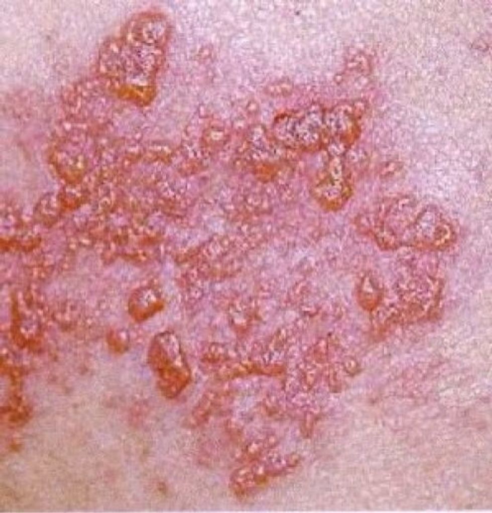This is a picture of a skin disease called shingles.