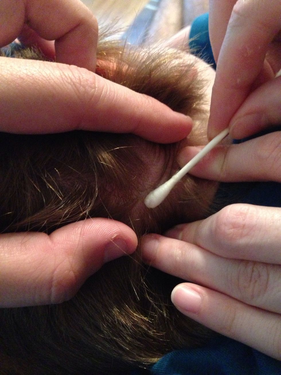 Use your Q-tip to rub some alcohol over the spot. Keep an eye on the bite mark for a few days. If a red circle (like a bullseye) shows up, it could be Lyme disease. In that case, go see the doctor.