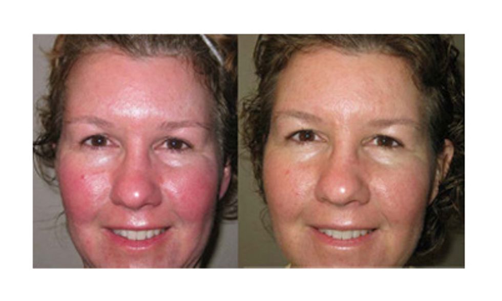 Vonda \u2013 Before & After using the SOOTHE Regimen