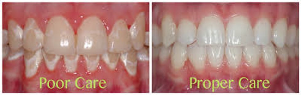 what can happen if you don't brush your teeth properly with braces