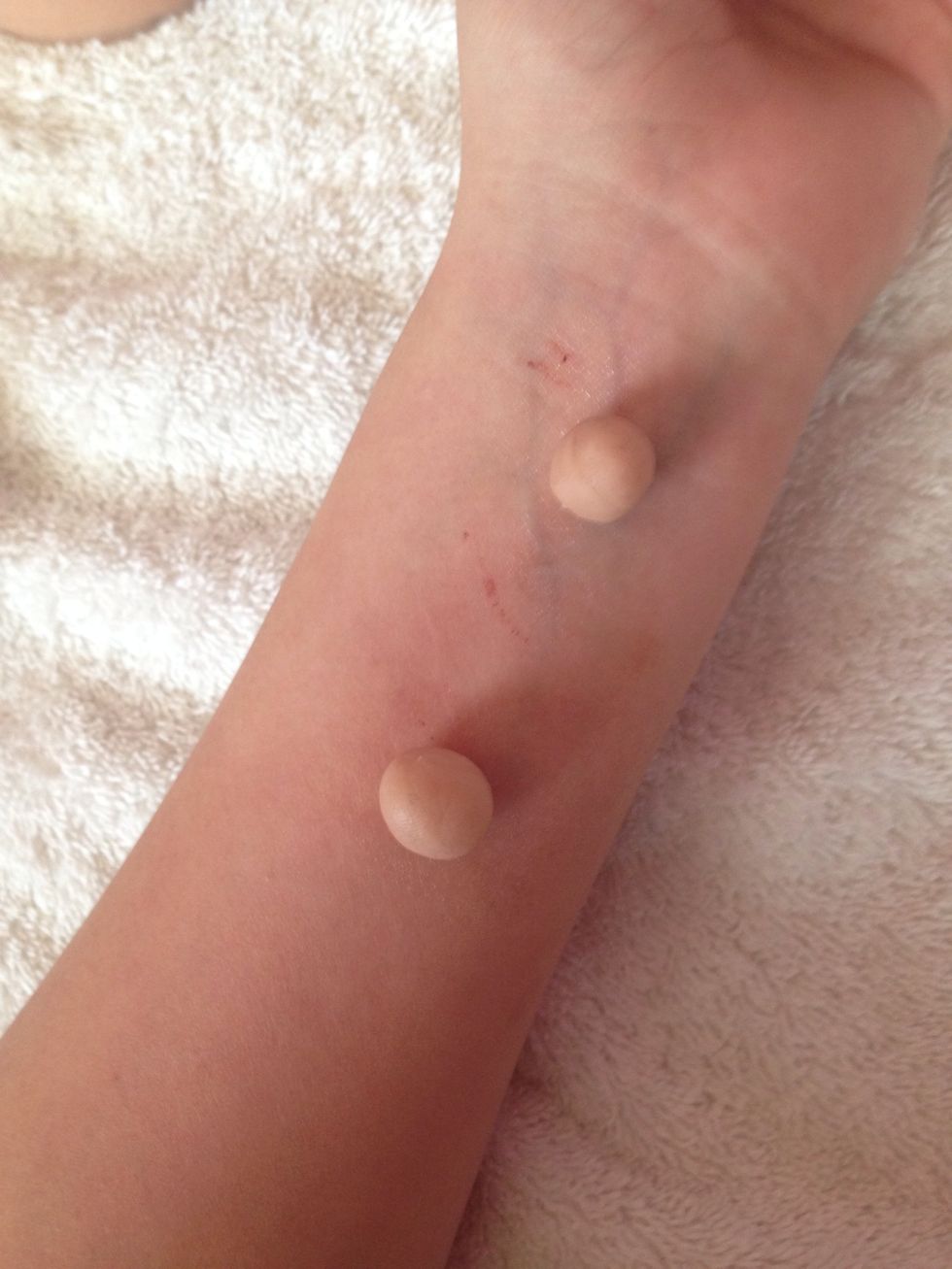 When tacky, apply scar wax