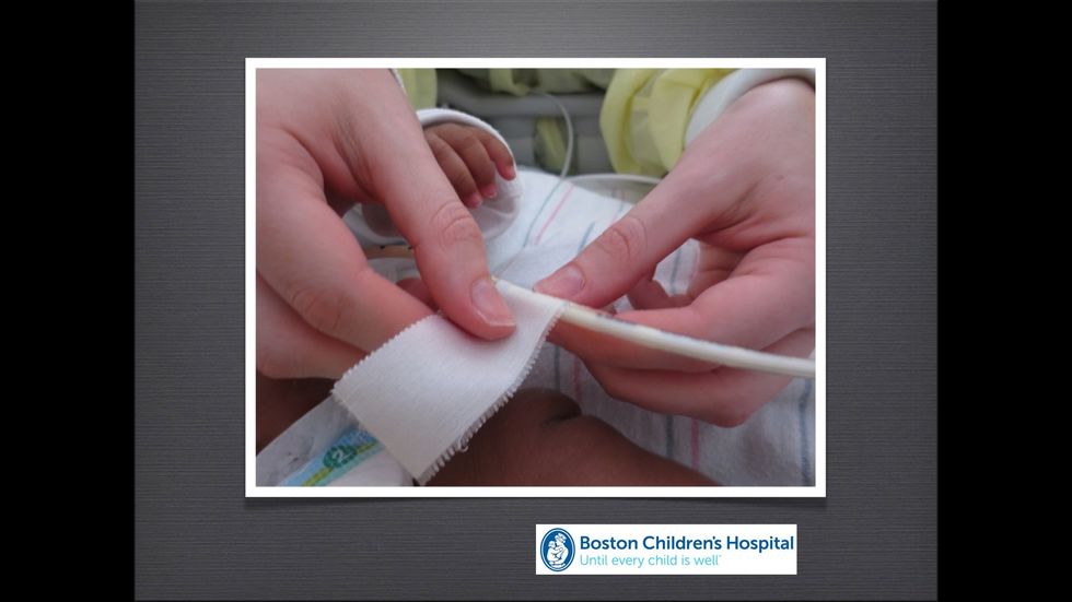 Wrap the tape completely around the PEG tube about 5-6 inches from the stoma.