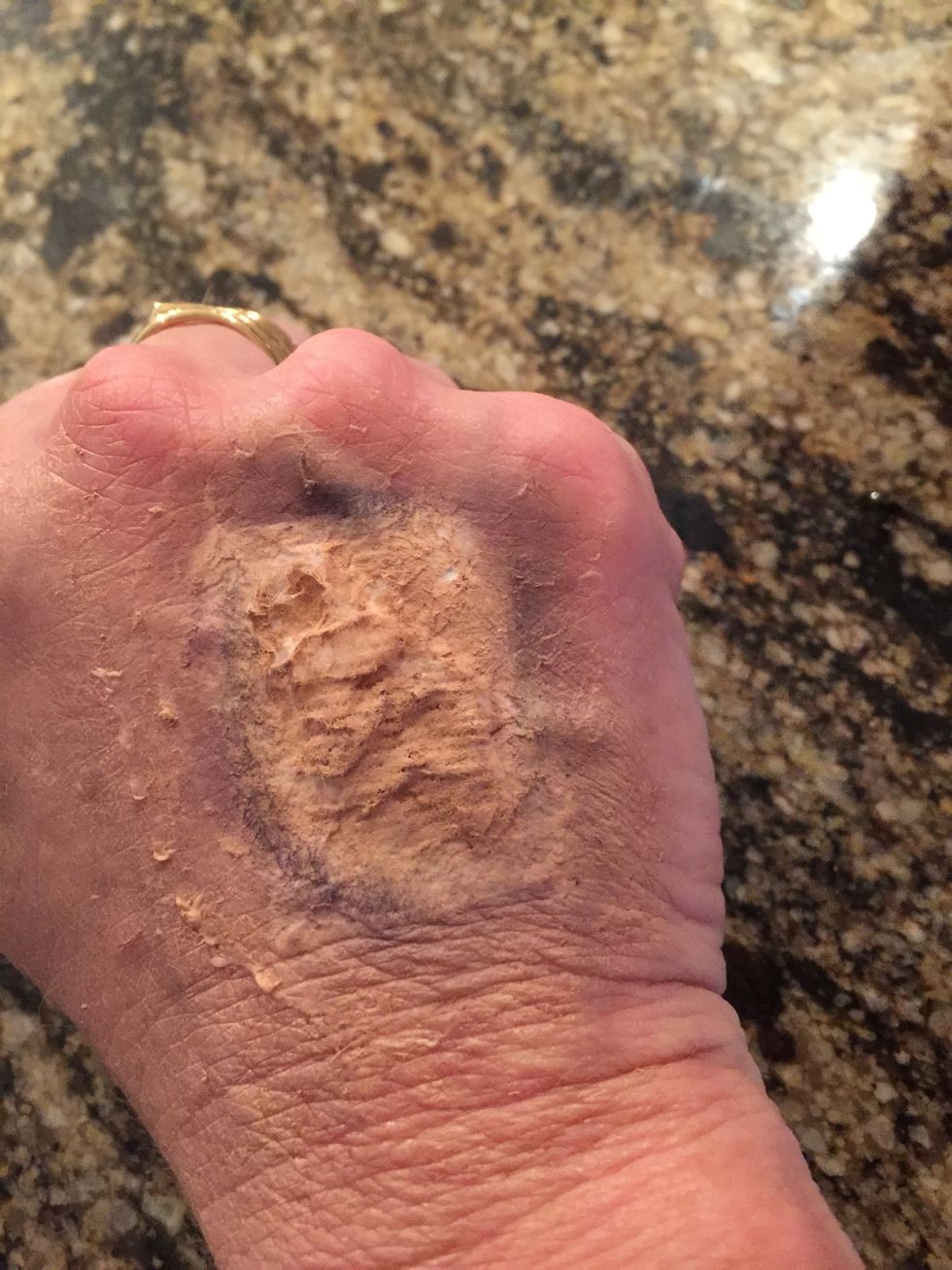 You can apply different shades of purple to give it a more realistic bruise.